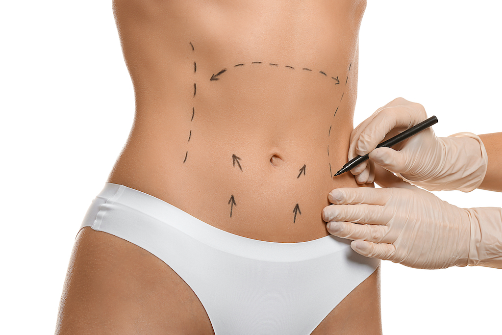 Tummy tuck