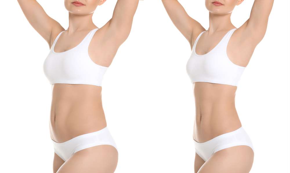 Liposuction