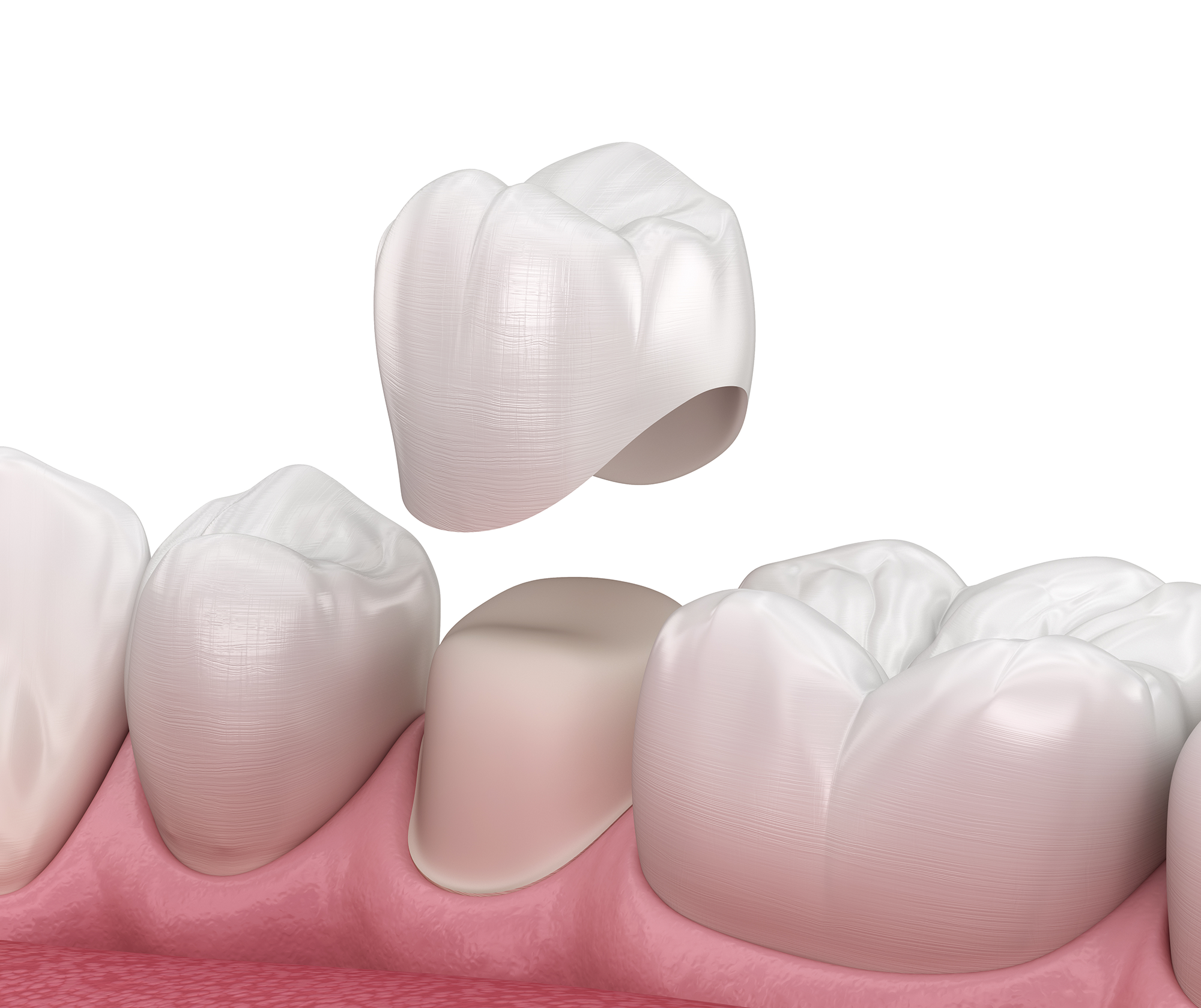 Dental Crowns